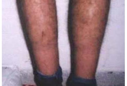 Etudiant blessé aux pieds