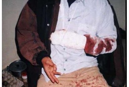 Un autre étudiant blessé à la main